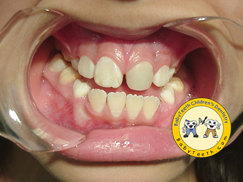 Internal Bleaching and Restoration