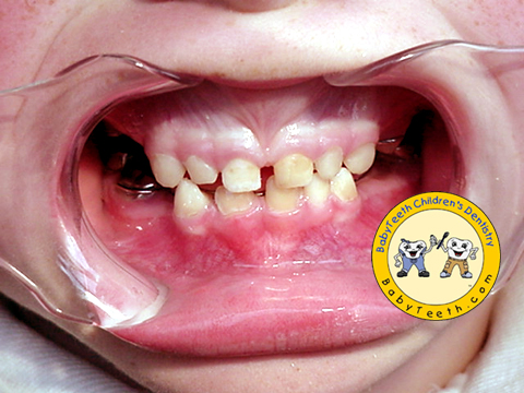 Full Mouth Reconstruction after Early Childhood Tooth Decay